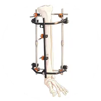 External Fixation
