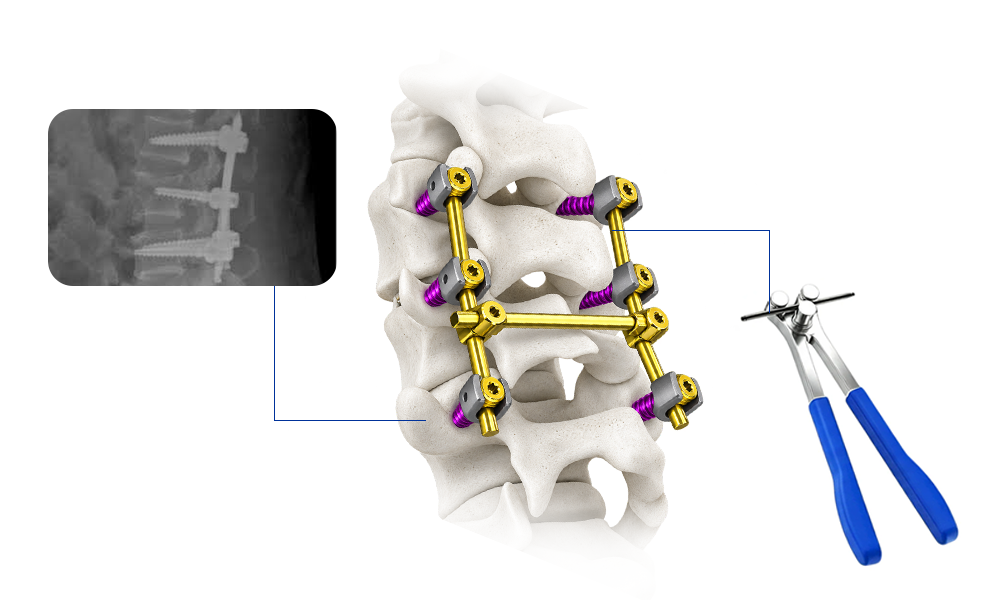 Head, shaft and locking interface details of the Davinmed 5.5 polyaxial short-tail pedicle screw