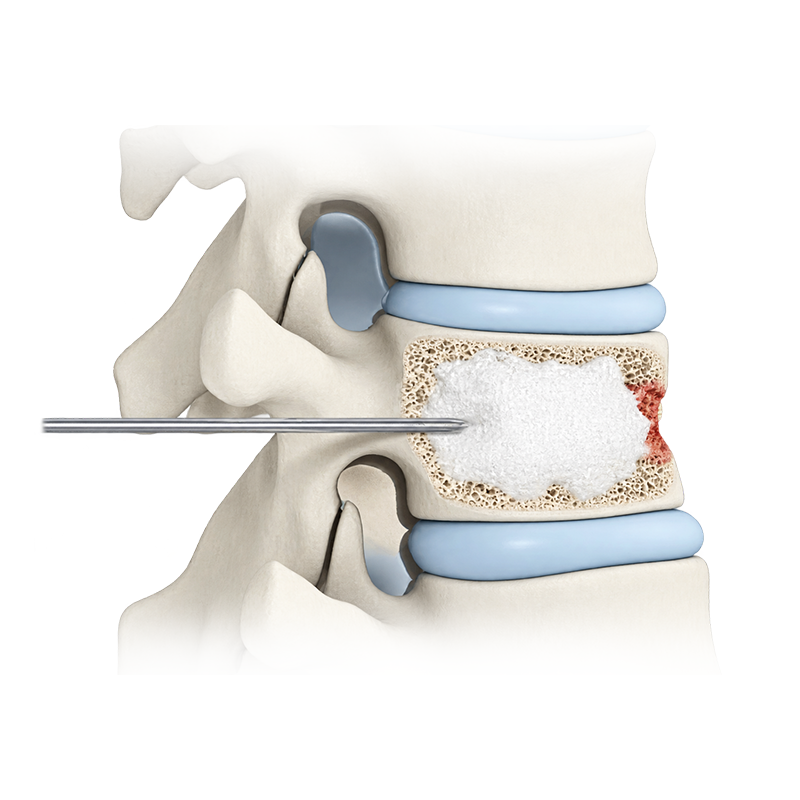Bone Cement