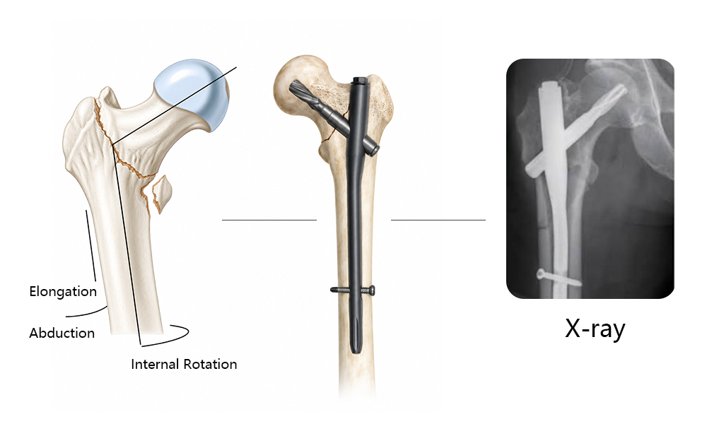 Meniscal suture device and repair component details