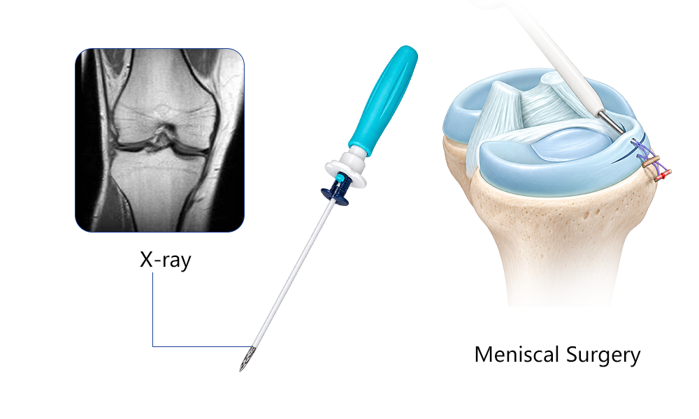 Meniscal suture device and repair component details