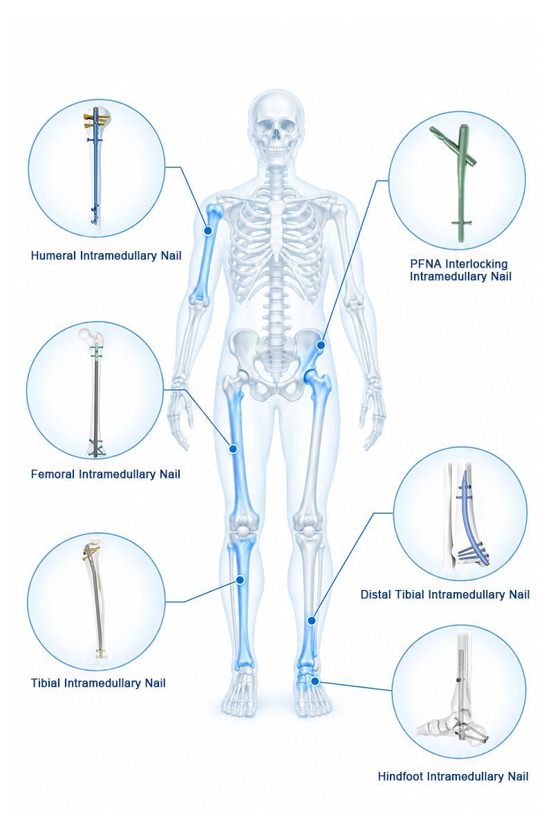 Intramedullary Nail System