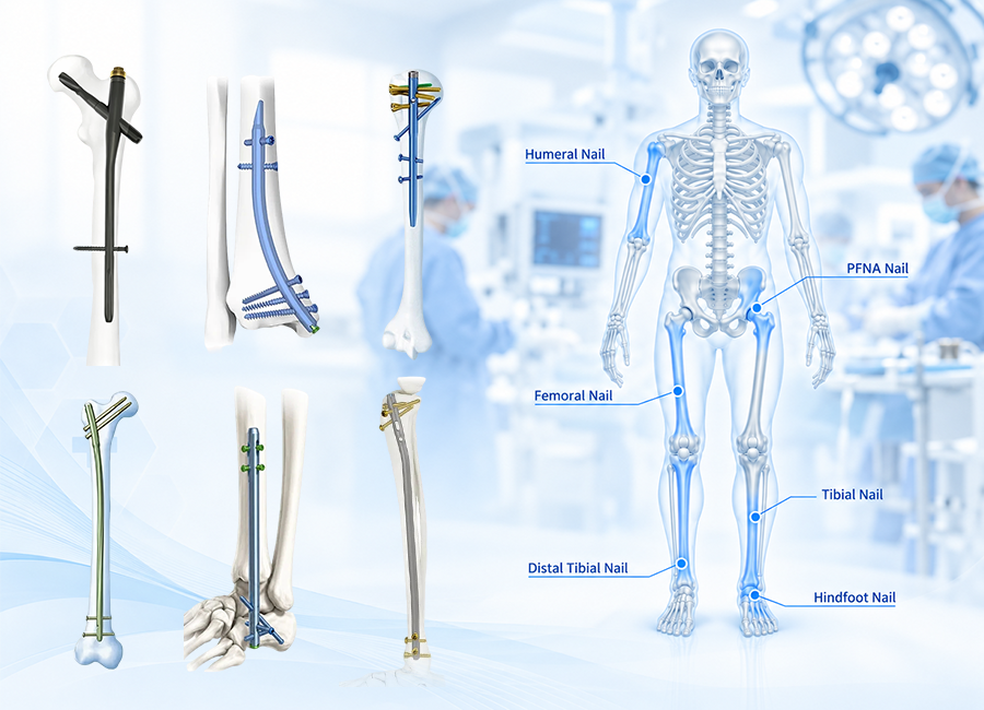 Intramedullary-Nailing-Surgical-Solution