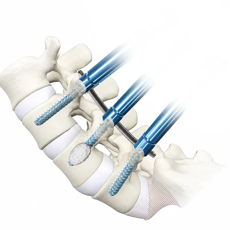 Minimally Invasive Pedicle Screw System
