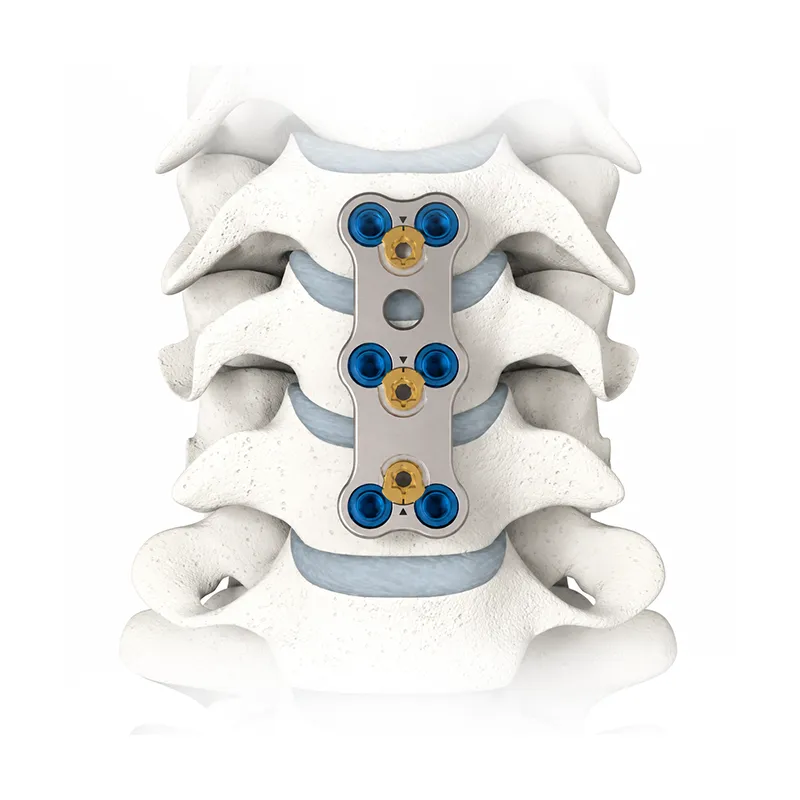 Anterior Cervical Fixation System