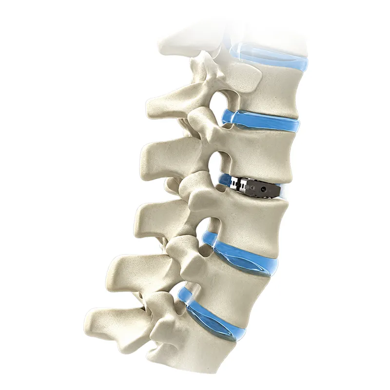 Interbody Fusion Cage System