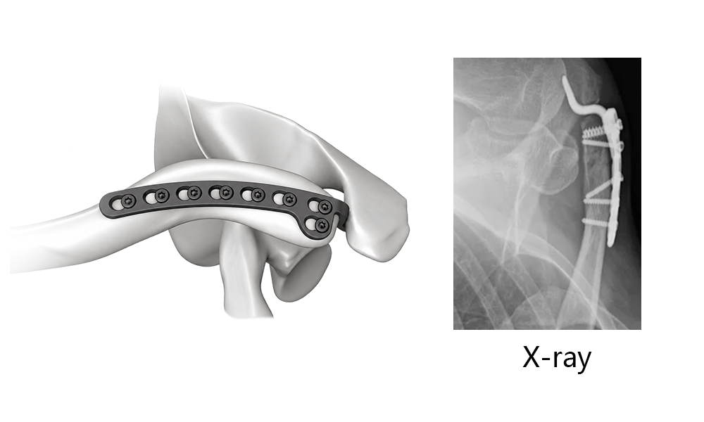 Clavicle Hook Locking Plate-II with fixation components