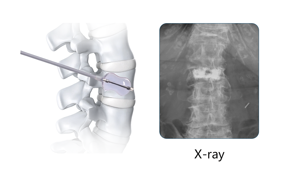 Vertebroplasty System with vertebral access and bone cement delivery components