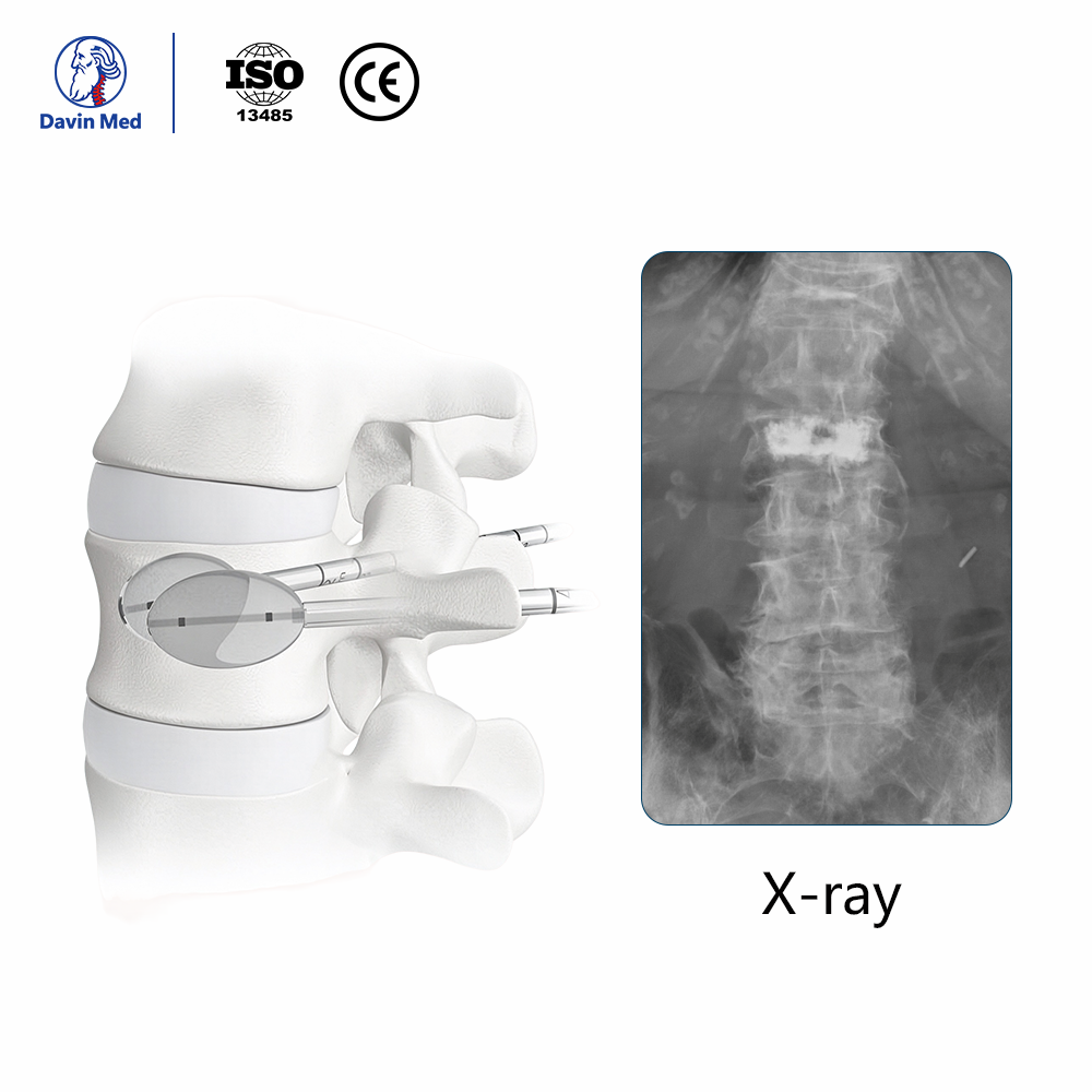 Davin-med-Vertebroplasty6
